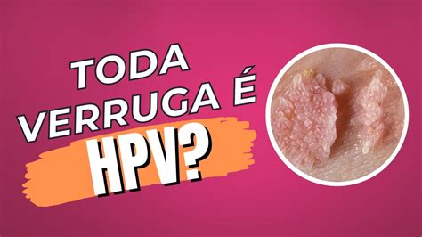 hpv 痣|HPV: o que é, sintomas, tratamentos e doenças provocadas pelo。